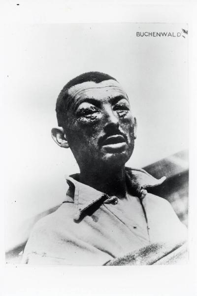 Seconda guerra mondiale - Germania - Campo di concentramento di Buchenwald - Nazismo - Liberazione - Ritratto maschile: prigioniero con volto tumefatto - Tortura