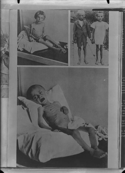 Seconda guerra mondiale - Nazismo - Polonia - Campo di concentramento di Auschwitz (?) - Liberazione - Bambini scheletriti sopravvissuti vittime degli esperimenti di Josef Mengele (?)
