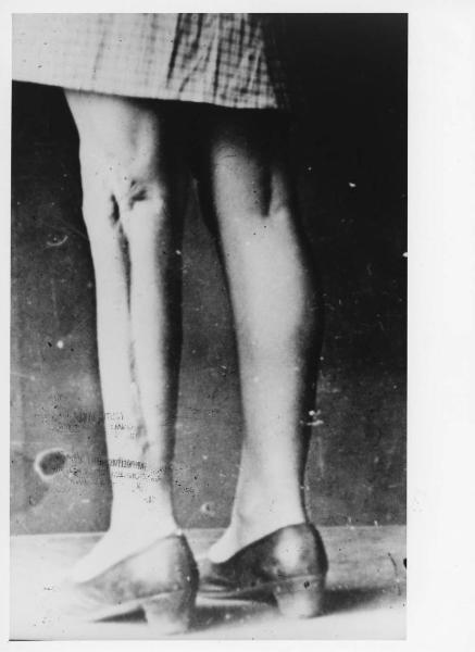 Seconda guerra mondiale - Nazismo - Germania, Norimberga (?) - Processo ai medici nazisti - Esperimenti chirurgici nel campo di concentramento di Ravensbrück - Gamba di donne con incisioni e cicatrici