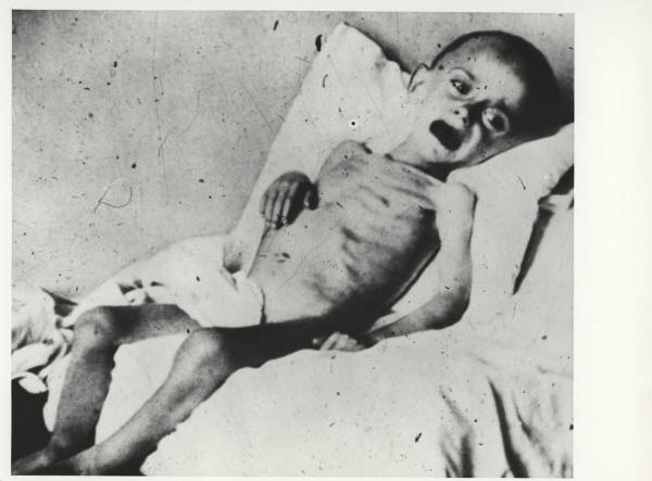 Seconda guerra mondiale - Polonia - Campo di concentramento di Auschwitz (?) - Nazismo - Liberazione - Ritratto infantile: bambino scheletrito sopravvissuto vittima degli esperimenti di Josef Mengele (?)