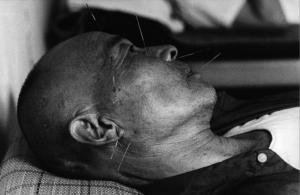 Cina - uomo sottoposto ad agopuntura