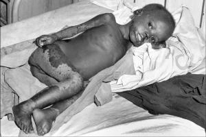 Reportage. Mozambico, Tete - Ospedale, interno - Ritratto infantile: bambino con malattia della pelle sdraiato nel letto - Macchie
