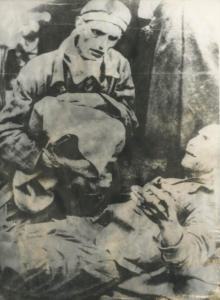 Seconda guerra mondiale - Nazismo - Germania - Campo di concentramento di Wobbelin - Liberazione - Ritratto maschile: prigionieri scheletriti sopravvissuti sofferenti - Divisa "pigiama" a strisce