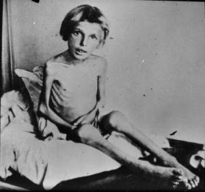 Seconda guerra mondiale - Polonia - Campo di concentramento di Auschwitz (?) - Nazismo - Dopo la liberazione - Bambina scheletrita sopravvissuta vittima degli esperimenti di Josef Mengele (?)