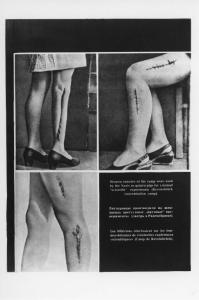 Seconda guerra mondiale - Nazismo - Germania, Norimberga - Processo ai medici nazisti - Esperimenti chirurgici nel campo di concentramento di Ravensbrück - Gambe di donne con incisioni e cicatrici
