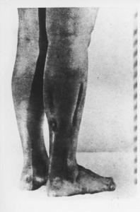 Seconda guerra mondiale - Nazismo - Germania - Campo di concentramento di Ravensbrück - Esperimenti chirurgici - Gambe di donna con incisioni e cicatrici