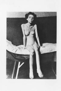 Seconda guerra mondiale - Campo di concentramento - Nazismo - Dopo la liberazione - Infermeria, interno - Ritratto femminile: donna sopravvissuta nuda, seduta su lettino da campo, vittima degli esperimenti nazisti